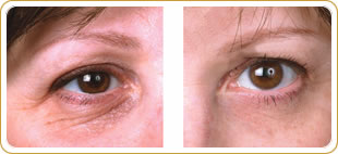 Eyevittal eye lift - before and after photos