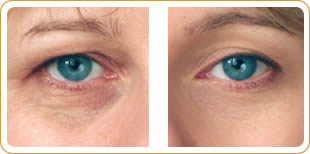 Before and after with Eyevittal Cosmetics
