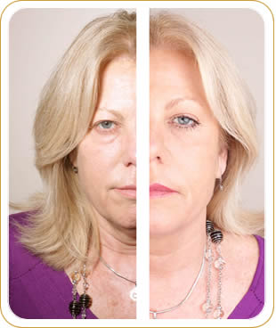 Faciallift face lift - before and after photos